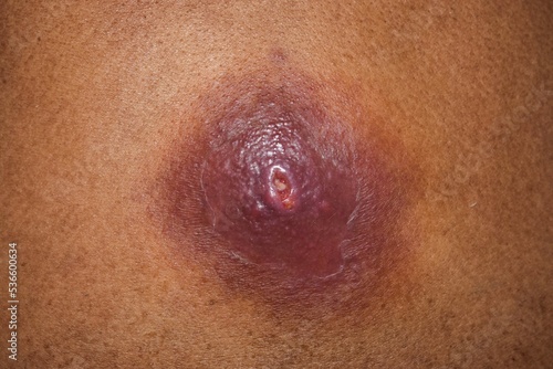 Large carbuncle or abscess at the back of Asian female patient. photo
