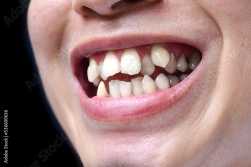 Stacked or overlapping white teeth. Also called crowded teeth.
