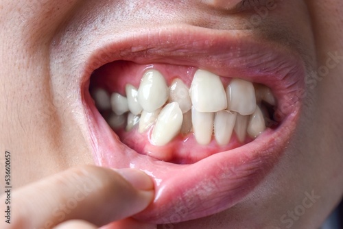 Stacked or overlapping white teeth. Also called crowded teeth.