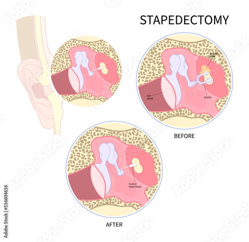 stapedectomy surgical for hearing loss and meniere's syndrome Balance problem