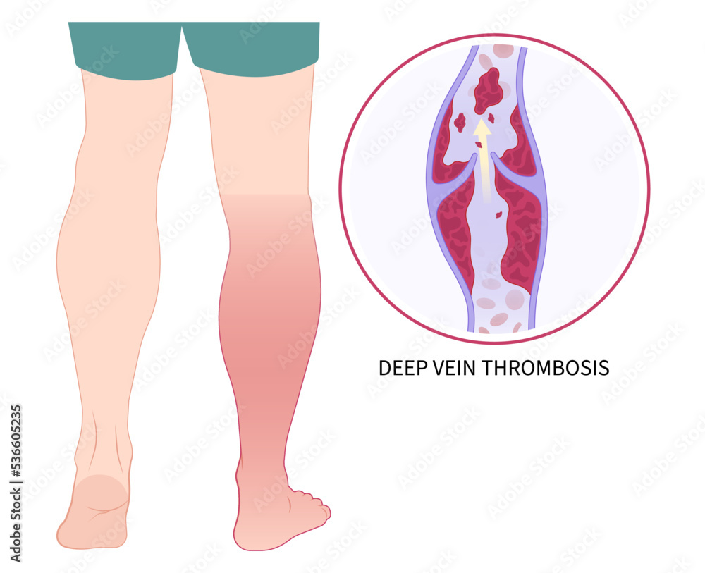 chronic Leg Pain varicose veins Swelling obesity ankle Foot diabetes