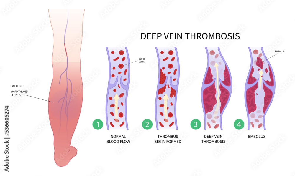 diabetes Foot chronic Leg Pain varicose veins Swelling obesity ankle