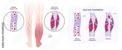 varicose veins Swelling chronic Leg Pain obesity ankle Foot diabetes syndrome Blood Clot disease photo