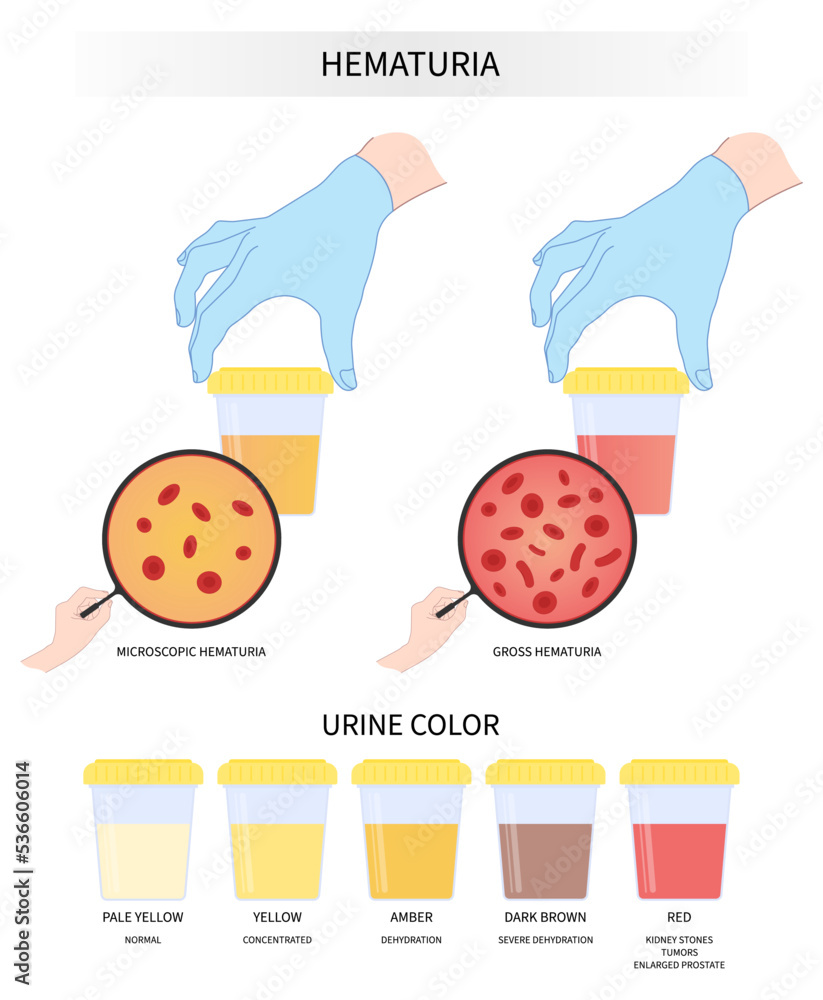 pee-color-after-dialysis-transplant-microscopic-urination-diagnostic
