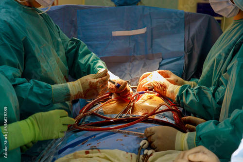 Fotografie Coronary artery bypass graft CABG is performed in the hospital operating room for treatment of heart diseases because coronary heart disease