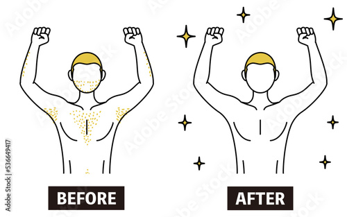 Image of medical hair removal, before-and-after of a man suffering from thick body hair being removed and becoming smooth.