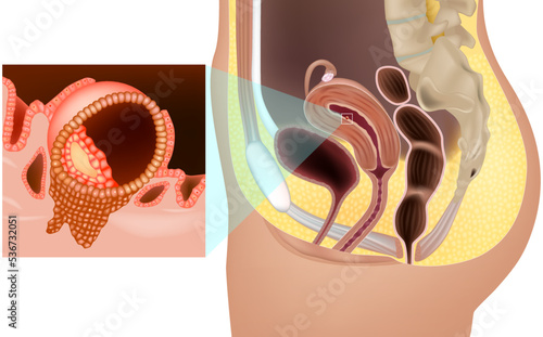 Implantation of fertilizedImplantation of fertilized ovum in uterus. Implanted human embryo in the womb.