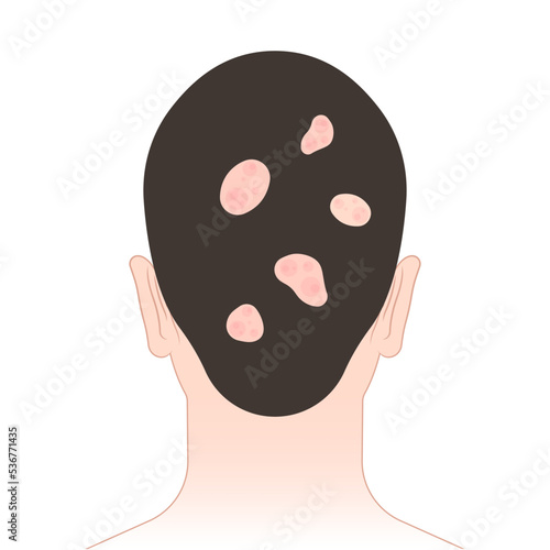 hair loss butterfly and malar rash chronic facial Pain joint inflammatory kidney failure Raynaud’s disease face purple pale