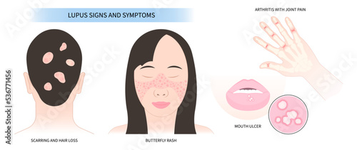 chronic facial Pain joint inflammatory butterfly and malar rash hair loss kidney failure Raynaud’s disease face purple pale photo