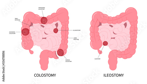 Colon Cancer Surgery for abdomen Pouch Small and Large ileum of Crohn and Hirschsprung disease blocked inflammation hernia stoma removal tract Rectal Tumor Loop invasive poo stool system photo