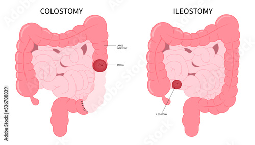 Large Colon removal with stoma Pouch Surgery on abdomen for Small Crohn and Hirschsprung poo stool disease blocked inflammation hernia Cancer tract Rectal system ileum Tumor Loop invasive