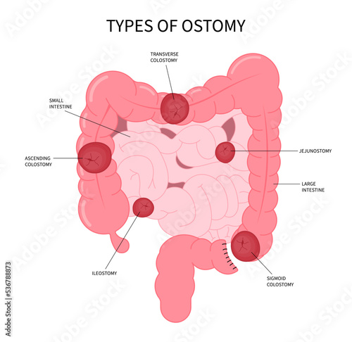 Small and Large Colon blocked Surgery abdomen Pouch with Crohn Hirschsprung disease inflammation of hernia stoma by removal Rectal tract poo stool system Cancer ileum Tumor Loop invasive photo