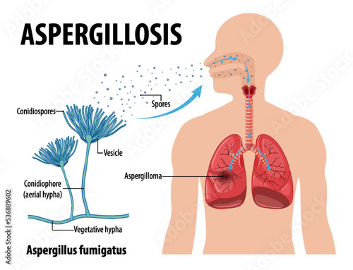 Diagram showing aspergillus infection