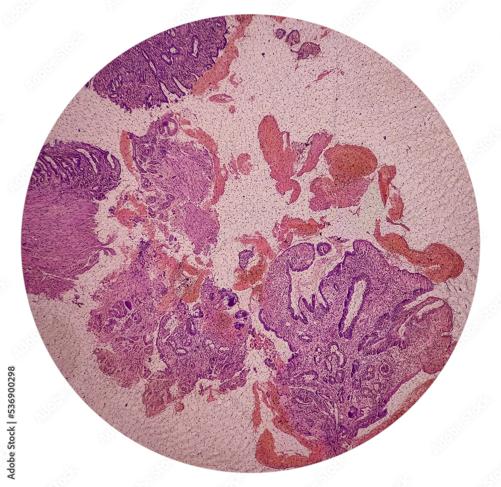 Tissue from gastro-jejunostomy stomal site (endoscopic biopsy): Chronic nonspecific gastritis with mild dysplasia. Show gastric mucosa, chronic inflammatory cells, lamina propria and dysplastic change Tissue from gastro-jejunostomy stomal site (endoscopic biopsy): Chronic nonspecific gastritis with mild dysplasia. Show gastric mucosa, chronic inflammatory cells, lamina propria and dysplastic change