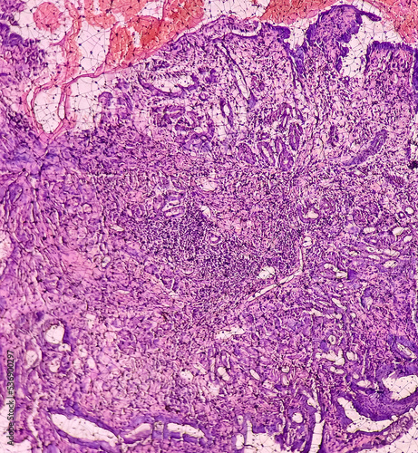 Tissue from gastro-jejunostomy stomal site (endoscopic biopsy): Chronic nonspecific gastritis with mild dysplasia. Show gastric mucosa, chronic inflammatory cells, lamina propria and dysplastic change