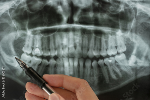 Close-up of panoramic dental x-ray. Pen points to abnormal location of wisdom teeth on lower jaw area.