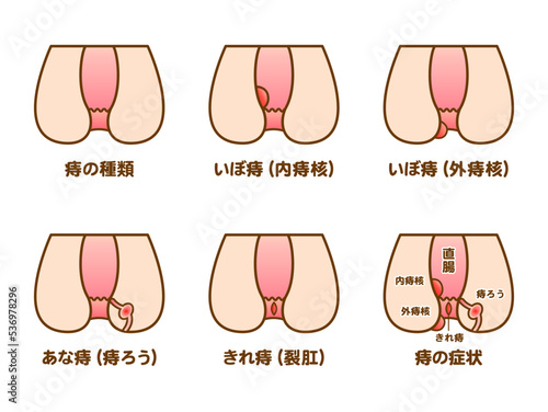 痔の症状の種類のベクター図解イラスト素材セット