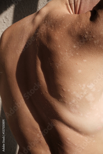 Close-up psoriasis skin, eczema, rash and other skin diseases. Spots on the skin. Naked neck, back, spine. Autoimmune genetic disease. Imperfect beauty, spinal curvature.