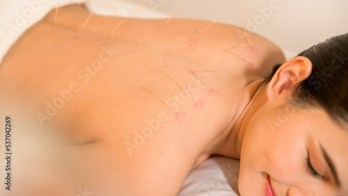 Beautiful Woman Received acupuncture treatment on back by  therapist  chinese medicine treatment  health and healing concept.