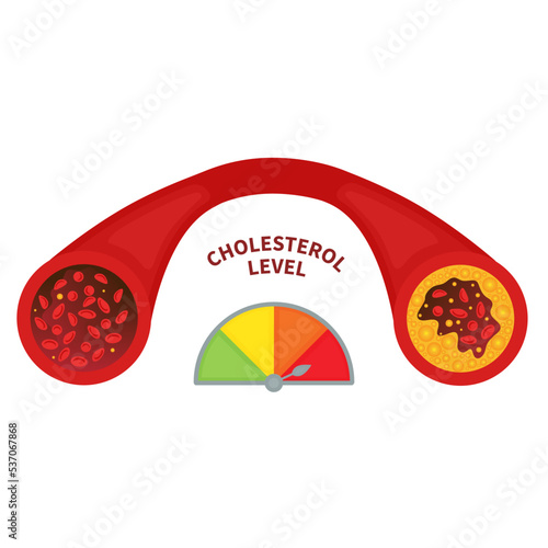 Cholesterol level in healthy and blocked blood vessel medical diagram. Meter gauge of ldl and hdl lipoprotein. High and low fat test indicator. Atherosclerosis risk. Vector illustration.