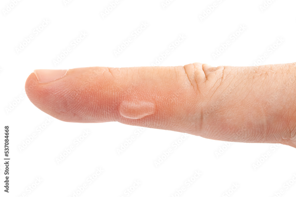 Fotka „blister on finger skin, human body damage callus, health care