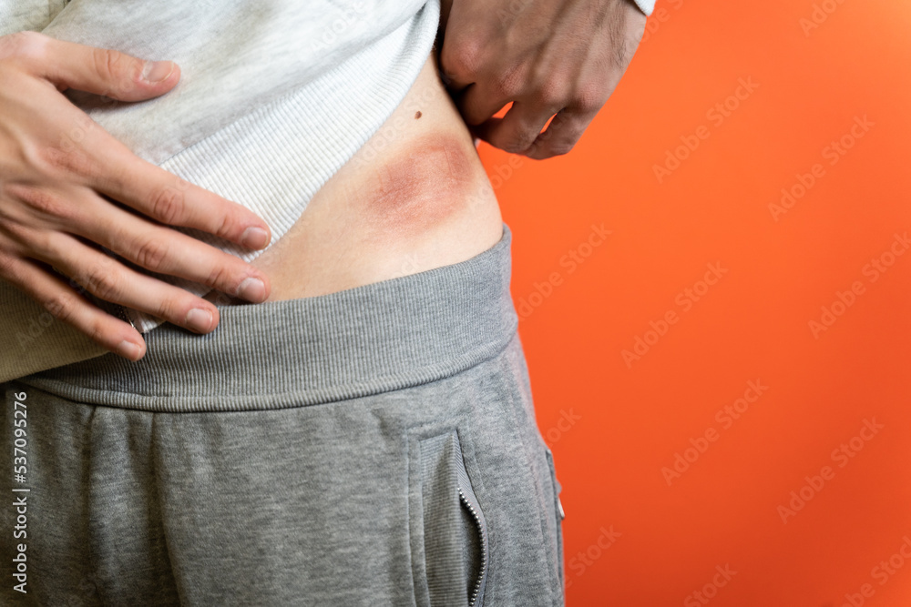 Bloody circular wound from an abdominal injury. Wound healing and