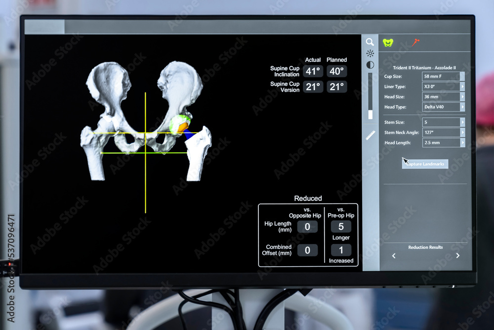 Team of doctor perform total hip arthroplasty replacement surgery in osteoarthritis patient