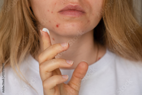 Unrecognizable woman applies makeup, cream serum cure for acne on face. Close-up acne on woman's face with rash skin ,scar and spot that allergic to cosmetics. Problem skincare and health concept photo