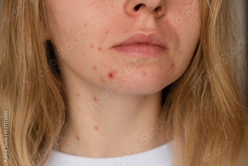 Obraz na plátně Unrecognizable woman showing her acne on face