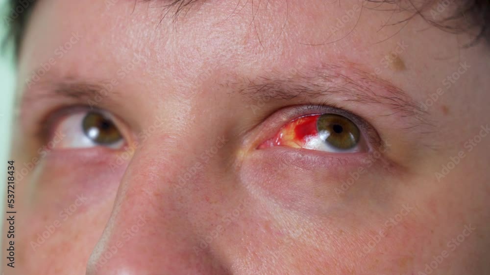 Infection or Injury to a man's eye , close-up macro Infection or Injury to a man's eye , close-up macro