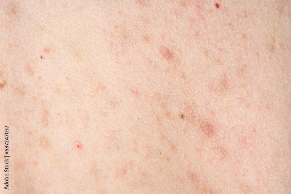 Skin with acne, with red spots. Health problem, skin diseases. Close up Allergy rash. Dermatitis problem of rash. Skin with acne, with red spots. Health problem, skin diseases. Close up Allergy rash. 