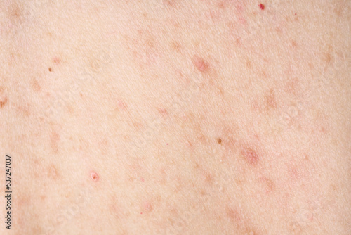 Skin with acne, with red spots. Health problem, skin diseases. Close up Allergy rash. Dermatitis problem of rash. Skin with acne, with red spots. Health problem, skin diseases. Close up Allergy rash. 