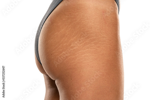 Quadro su tela Female tanned hips with a stretch marks and cellulite on white background