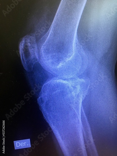Film x-ray human's knee joints
