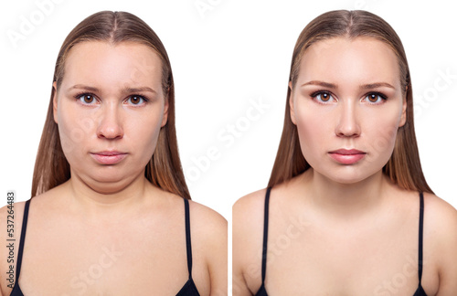 Woman before and after chin correction. Plastic surgery concept. photo
