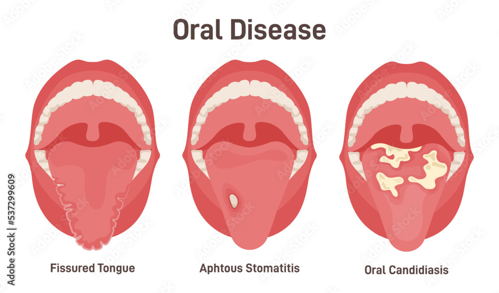 Tongue problems set. Fissured tongue, oral candidiasis and aphthous
