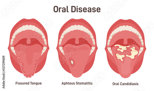 Tongue problems set. Fissured tongue, oral candidiasis and aphthous
