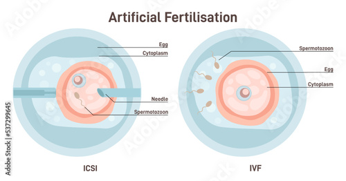 Artificial fertilization types. Female egg insemination by sperm with IVF