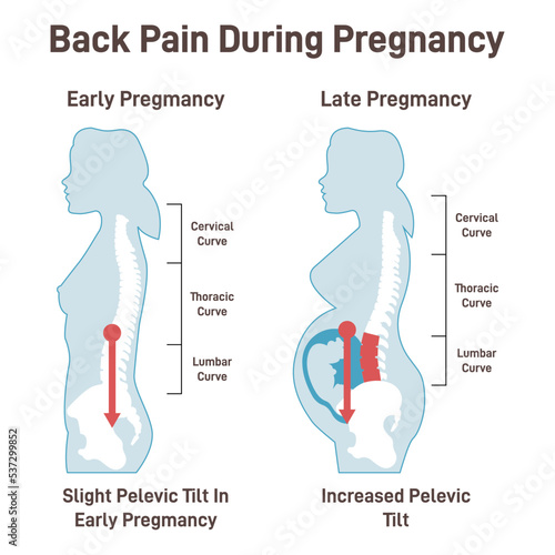 Back pain during pregnancy. Pregnant woman experiencing extreme