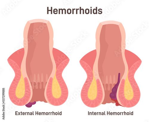 Two types of hemorrhoids. Internal and external hemorrhoidal