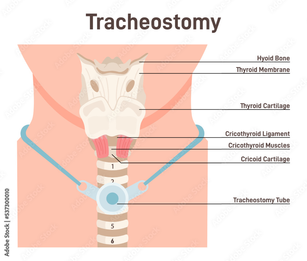 Tracheostomy. Tracheal surgery neutralise airway obstruction. Plastic