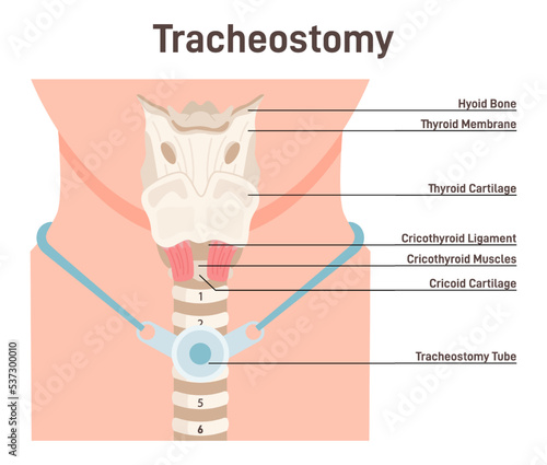 Tracheostomy. Tracheal surgery neutralise airway obstruction. Plastic cannula