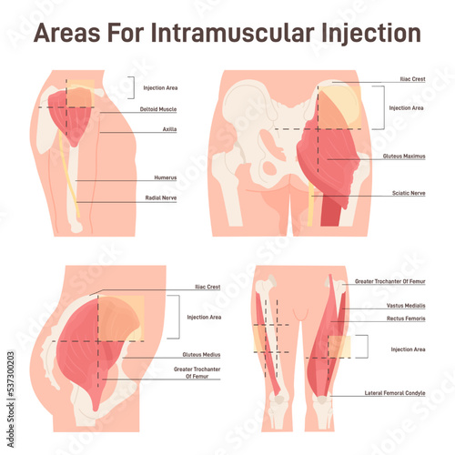 Intramuscular injection areas. Guide to injecting medication into muscle