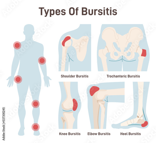 Types of bursitis set. Shoulder, hip, heel, knee and elbow joints inflammation. photo