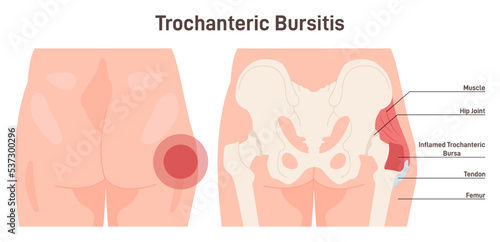 Bursitis. Hip joint inflammation. Inflamed or irritated bursae of synovial