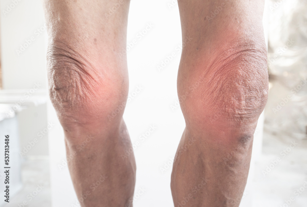 Naklejka premium Leg and knee of an old man with muscle problems. bone and marrow