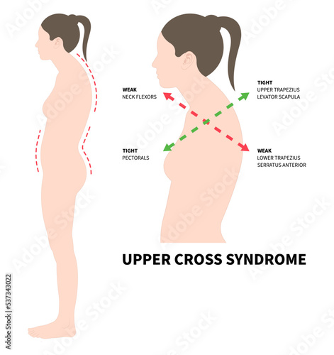body poor and Postural anterior pelvic tilt upper cross syndrome trapezius of dowager’s painful spinal with Scheuermann's rounded Disk care