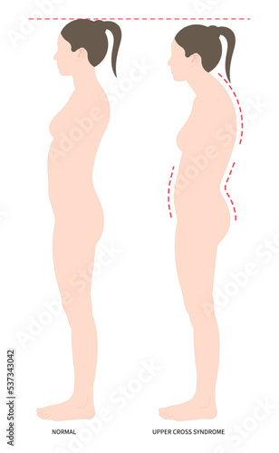 body poor and Postural anterior pelvic tilt upper cross syndrome trapezius of dowager’s painful spinal with Scheuermann's rounded Disk care