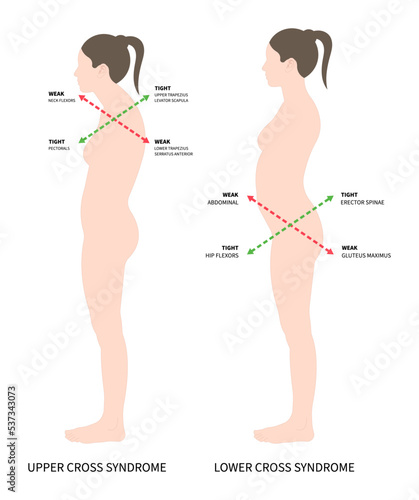 anterior pelvic tilt upper cross syndrome with trapezius and dowager’s painful spinal of Scheuermann's rounded Disk body poor Postural care