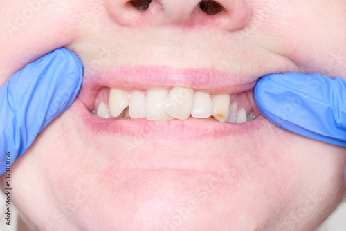 Adult woman teeth with malocclusion close up, orthodontic problem and preparing for treatment, crooked teeth before installing braces